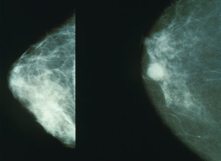 mammography.jpg