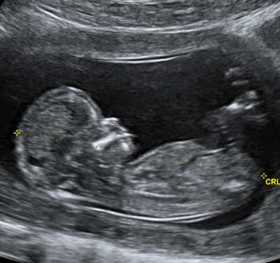 ultrasound.jpg