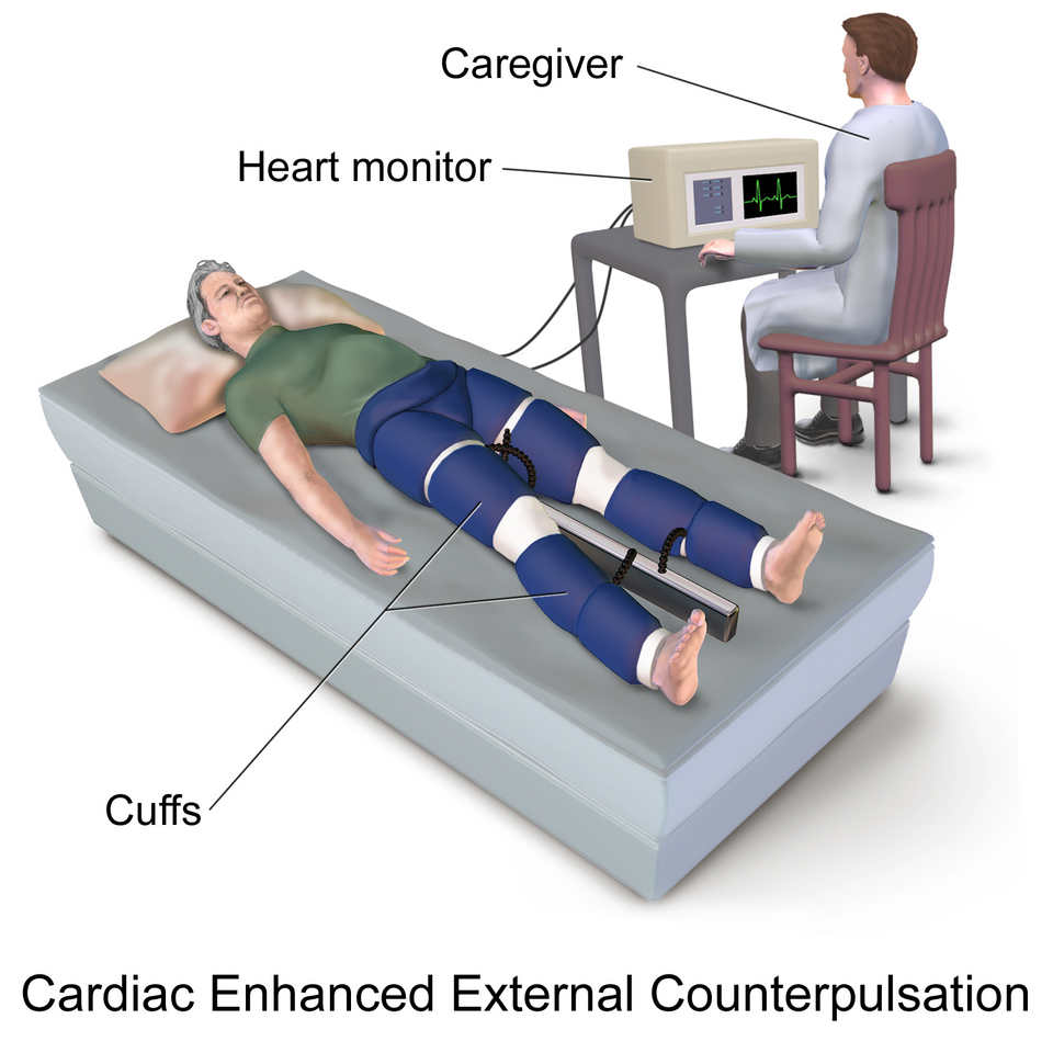 externalCounterpulsation.jpg