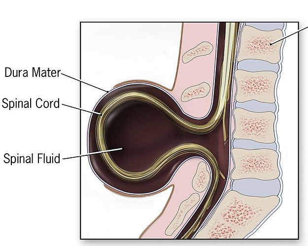 spinaBifida.jpg