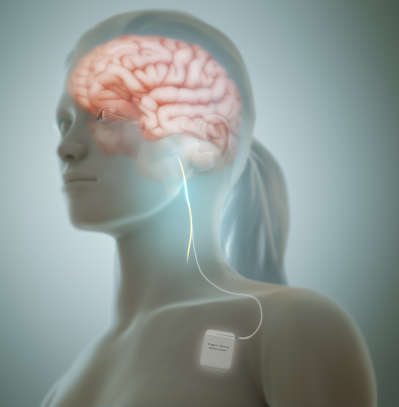 vagusNerveStimulation.jpg