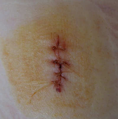 wound.jpg